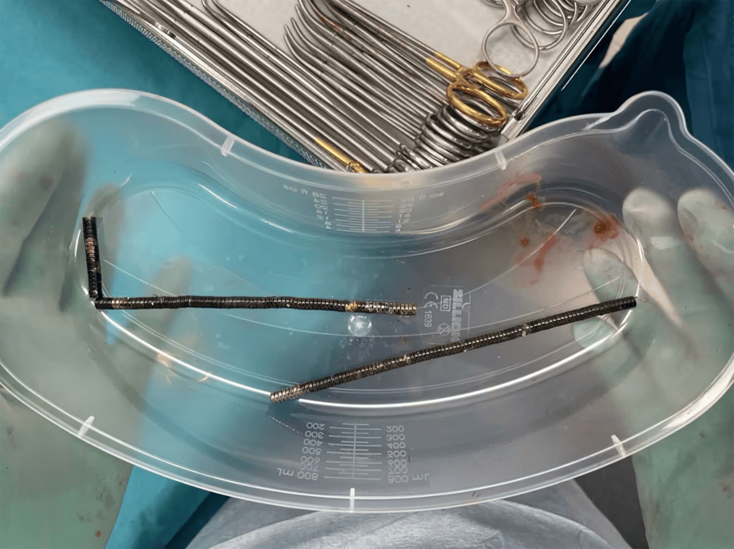 腹痛4天后送医，新西兰男孩吞下约100颗磁铁致肠道坏死 医生切除部分肠组织